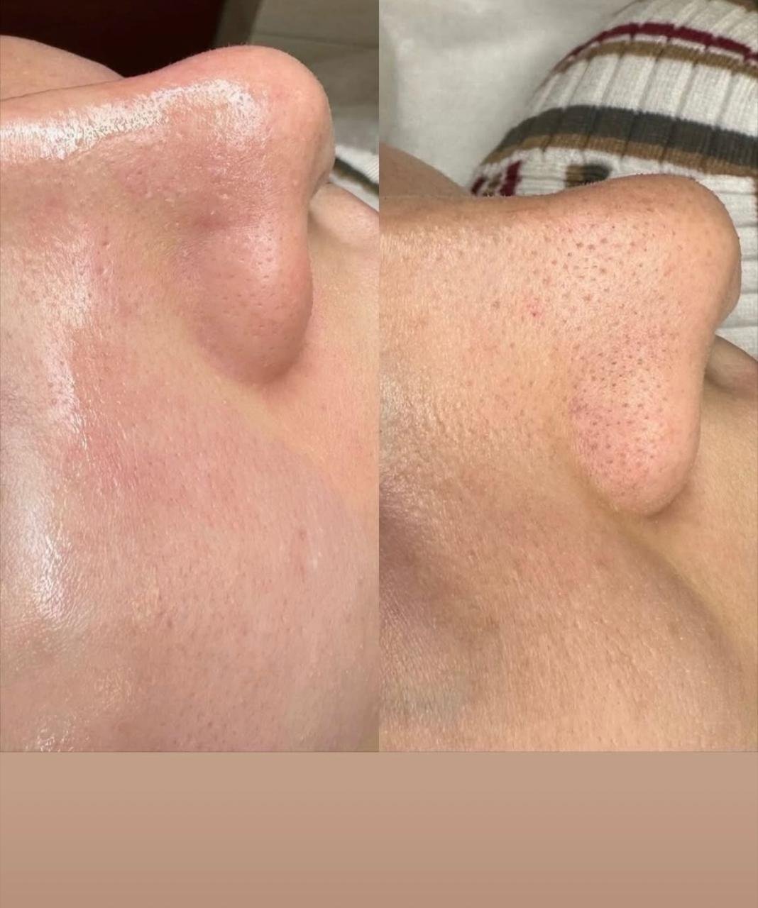 Embellir les lèvres - Avant et Après